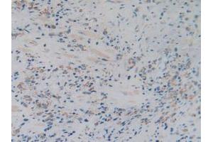 IHC-P analysis of Human Prostate Gland Cancer Tissue, with DAB staining. (C1QBP Antikörper  (AA 76-282))