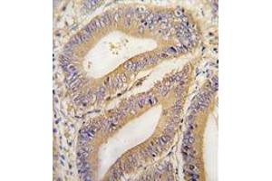 Formalin-fixed and paraffin-embedded human colon carcinoma tissue reacted with PHB2 Antibody (N-term) , which was peroxidase-conjugated to the secondary antibody, followed by DAB staining. (Prohibitin 2 Antikörper  (N-Term))