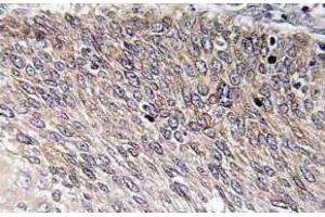 Immunohistochemistry (IHC) analyzes of p-VASP antibody in paraffin-embedded human cervix carcinoma tissue. (VASP Antikörper  (pSer238))