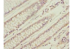 Immunohistochemistry of paraffin-embedded human colon cancer using ABIN7166319 at dilution of 1:100