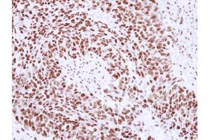 IHC-P Image Immunohistochemical analysis of paraffin-embedded human breast cancer, using SNRPA, antibody at 1:250 dilution. (SNRPA1 Antikörper  (C-Term))