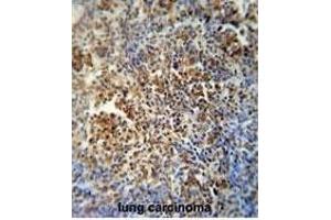 F1 antibody (Center) (ABIN654163 and ABIN2844027) immunohistochemistry analysis in forlin fixed and paraffin embedded hun lung carcino followed by peroxidase conjugation of the secondary antibody and DAB staining. (MAF1 Antikörper  (AA 90-117))