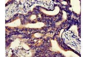 Immunohistochemistry of paraffin-embedded human colon cancer using ABIN7144881 at dilution of 1:100 (ABCA5 Antikörper  (AA 1230-1355))