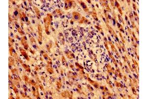 Immunohistochemistry of paraffin-embedded human liver cancer using ABIN7162762 at dilution of 1:100 (MTRF1 Antikörper  (AA 285-433))