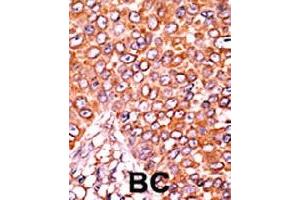 Formalin-fixed and paraffin-embedded human cancer tissue reacted with CDKN1B (phospho T157) polyclonal antibody  which was peroxidase-conjugated to the secondary antibody followed by AEC staining. (CDKN1B Antikörper  (pThr157))