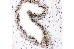 Anti-VCP antibody, IHC(P) IHC(P): Human Mammary Cancer Tissue (VCP Antikörper  (C-Term))