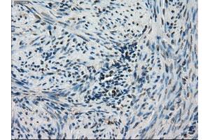 Immunohistochemical staining of paraffin-embedded Carcinoma of thyroid tissue using anti-STK39mouse monoclonal antibody. (STK39 Antikörper)