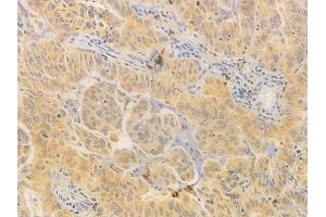 ABIN6261619 and ABIN6276751 at 1/100 staining human lung adenocarcinoma by IHC-P.
