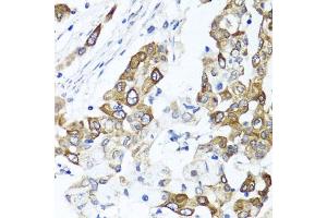 Immunohistochemistry of paraffin-embedded human colon carcinoma using PPOX antibody (ABIN6129092, ABIN6146051, ABIN6146052 and ABIN6222026) at dilution of 1:100 (40x lens). (PPOX Antikörper  (AA 1-280))