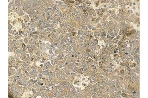 ABIN6259273 and ABIN6273655 at 1/100 staining human melanoma by IHC-P. (FIL1h Antikörper  (C-Term))