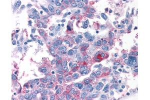 Anti-T1R1 / TAS1R1 antibody IHC of human Ovary, Carcinoma.