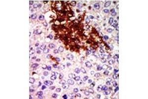 Formalin-fixed and paraffin-embedded human cancer tissue (breast carcinoma) reacted with the primary antibody, which was peroxidase-conjugated to the secondary antibody, followed by DAB staining. (RIOK1 Antikörper  (N-Term))