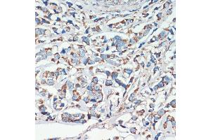 Immunohistochemistry of paraffin-embedded human breast cancer using APC antibody (ABIN1678689, ABIN1678690, ABIN5664154 and ABIN6219837) at dilution of 1:200 (40x lens). (APC Antikörper  (AA 2544-2843))