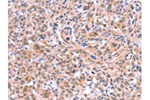 The image on the left is immunohistochemistry of paraffin-embedded Human esophagus cancer tissue using ABIN7128670(BMPR2 Antibody) at dilution 1/35, on the right is treated with fusion protein. (BMPR2 Antikörper)
