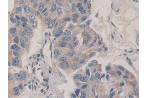 Detection of CDH16 in Human Breast cancer Tissue using Polyclonal Antibody to Cadherin 16 (CDH16) (Cadherin-16 Antikörper  (AA 37-287))