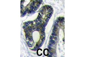 Formalin-fixed and paraffin-embedded human colon carcinoma reacted with FAU polyclonal antibody  , which was peroxidase-conjugated to the secondary antibody, followed by DAB staining. (FAU Antikörper  (C-Term))