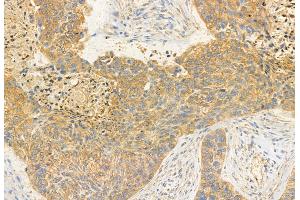 ABIN6260209 and ABIN6272937 at 1/100 staining Human lung cancer by IHC-P. (BBS2 Antikörper  (C-Term))