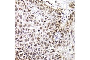 Immunohistochemistry of paraffin-embedded human well-differentiated squamous skin carcinoma using PHIP antibody (ABIN5974339) at dilution of 1/100 (40x lens). (PHIP Antikörper)