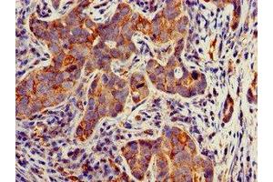 Immunohistochemistry of paraffin-embedded human pancreatic cancer using ABIN7171684 at dilution of 1:100 (TECPR2 Antikörper  (AA 516-783))