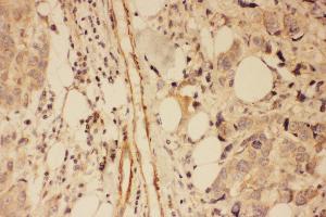 Anti-PSD95 antibody, IHC(P) IHC(P): Human Mammary Cancer Tissue (DLG4 Antikörper  (C-Term))