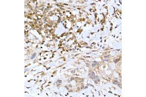 Immunohistochemistry of paraffin-embedded human breast cancer using TFEB Rabbit pAb (ABIN6128819, ABIN6149043, ABIN6149045 and ABIN6223149) at dilution of 1:100 (40x lens). (TFEB Antikörper)