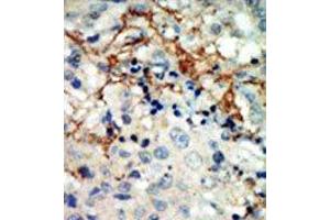 Formalin-fixed and paraffin-embedded human cancer tissue reacted with the primary antibody, which was peroxidase-conjugated to the secondary antibody, followed by AEC staining. (EPH Receptor A3 Antikörper  (N-Term))