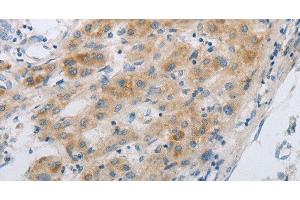 Immunohistochemistry of paraffin-embedded Human liver cancer using GJB6 Polyclonal Antibody at dilution of 1:30 (GJB6 Antikörper)