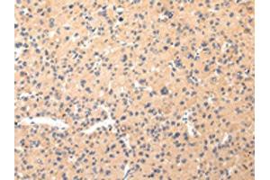 The image on the left is immunohistochemistry of paraffin-embedded Human liver cancer tissue using ABIN7190330(COL8A2 Antibody) at dilution 1/20, on the right is treated with synthetic peptide. (COL8a2 Antikörper)