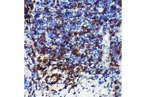 Immunohistochemistry of paraffin-embedded human lung cancer using CD4 Rabbit mAb (ABIN7266195) at dilution of 1:100 (40x lens).