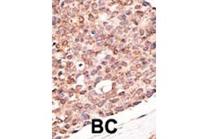 Formalin-fixed and paraffin-embedded human breast cancer tissue reacted with CRY2 polyclonal antibody  , which was peroxidase-conjugated to the secondary antibody, followed by DAB staining. (CRY2 Antikörper  (C-Term))