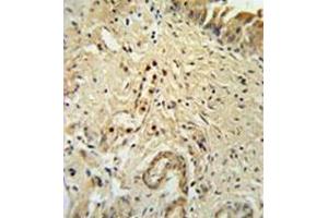 Immunohistochemistry analysis in formalin fixed and paraffin embedded bladder carcinoma reated with ID4 Antibody (N-term) followed which was peroxidase conjugated to the secondary antibody and followed by DAB staining. (ID4 Antikörper  (N-Term))