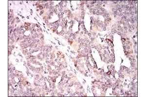 Immunohistochemical analysis of paraffin-embedded human ovarian cancer tissues using KIF11 mouse mAb with DAB staining.