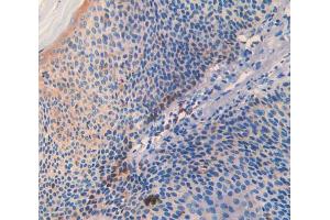 IHC-P analysis of skin cancer tissue, with DAB staining. (SLIT3 Antikörper  (AA 1405-1512))