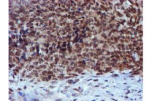 Immunohistochemical staining of paraffin-embedded Adenocarcinoma of Human breast tissue using anti-RFXANK mouse monoclonal antibody.