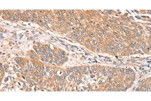 Immunohistochemistry of paraffin-embedded Human lung cancer using RPS6KA1 Polyclonal Antibody at dilution of 1:30 (RPS6KA1 Antikörper)