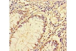 Immunohistochemistry of paraffin-embedded human colon cancer using ABIN7143489 at dilution of 1:100 (ARL16 Antikörper  (AA 1-197))