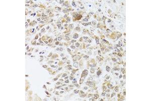 Immunohistochemistry of paraffin-embedded human lung cancer using RNASEL antibody. (RNASEL Antikörper)