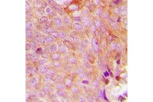 Immunohistochemical analysis of MRPS9 staining in human breast cancer formalin fixed paraffin embedded tissue section. (MRPS9 Antikörper)