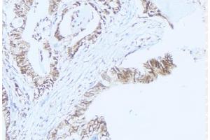 ABIN6275467 at 1/100 staining Human lung cancer tissue by IHC-P.