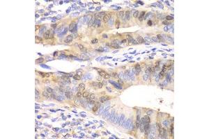 Immunohistochemistry of paraffin-embedded human colon carcinoma using UBE2C antibody. (UBE2C Antikörper  (AA 1-179))