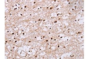 The image on the left is immunohistochemistry of paraffin-embedded Human brain tissue using ABIN7130476(NUP50 Antibody) at dilution 1/30, on the right is treated with fusion protein. (NUP5 Antikörper)