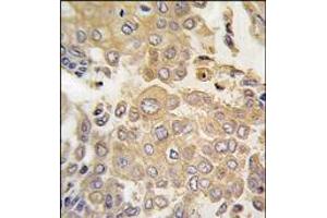 Formalin-fixed and paraffin-embedded human lung carcinoma tissue reacted with MAPK4 antibody (N-term), which was peroxidase-conjugated to the secondary antibody, followed by DAB staining. (MAPK4 Antikörper  (N-Term))