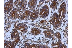 IHC-P Image Immunohistochemical analysis of paraffin-embedded human colon carcinoma, using alpha Tubulin, antibody at 1:500 dilution. (TUBA1B Antikörper)