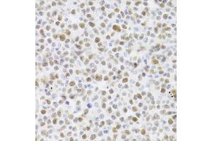 Immunohistochemistry of paraffin-embedded human B cell lymphoma using TP53 Antibody (ABIN5971632) at dilution of 1/100 (40x lens). (p53 Antikörper)
