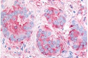Human Breast Carcinoma (formalin-fixed, paraffin-embedded) stained with VEGFR2 antibody ABIN213630 at 2. (VEGFR2/CD309 Antikörper  (Internal Region))