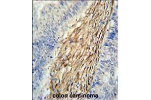 C3orf75 Antibody immunohistochemistry analysis in formalin fixed and paraffin embedded human colon carcinoma followed by peroxidase conjugation of the secondary antibody and DAB staining.