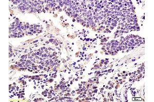 Formalin-fixed and paraffin embedded human lung carcinoma labeled with Anti-Integrin alpha 7/ITGA7 Polyclonal Antibody, Unconjugated (ABIN734858) at 1:200 followed by conjugation to the secondary antibody and DAB staining. (ITGA7 Antikörper  (AA 701-800))