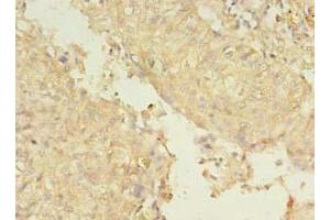 Immunohistochemistry of paraffin-embedded human lung cancer using ABIN7151226 at dilution of 1:100 (SMURF2 Antikörper  (AA 1-748))