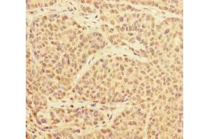 Immunohistochemistry of paraffin-embedded human ovarian cancer using ABIN7174174 at dilution of 1:100