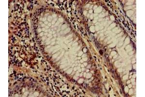 Immunohistochemistry of paraffin-embedded human colon cancer using ABIN7155043 at dilution of 1:100 (c-MET Antikörper  (AA 83-209))